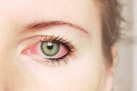 red irritated eyes