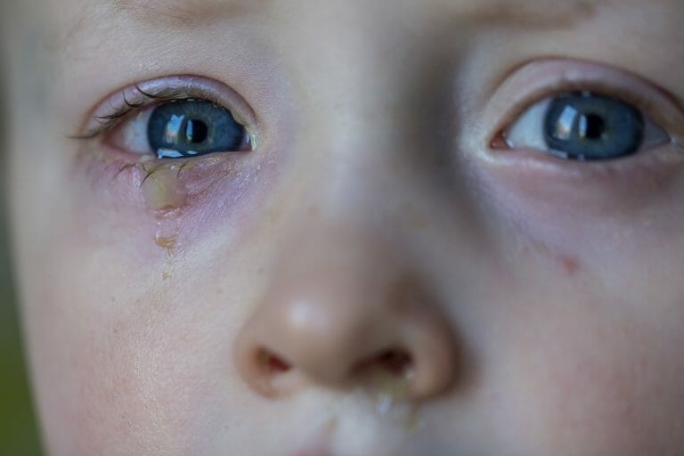 Baby eye discharge