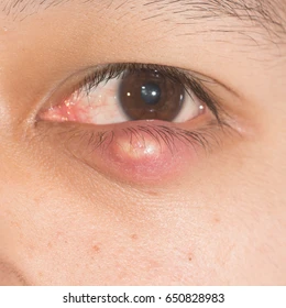 Eye bumps