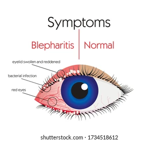 Blepharitis Home Treatment