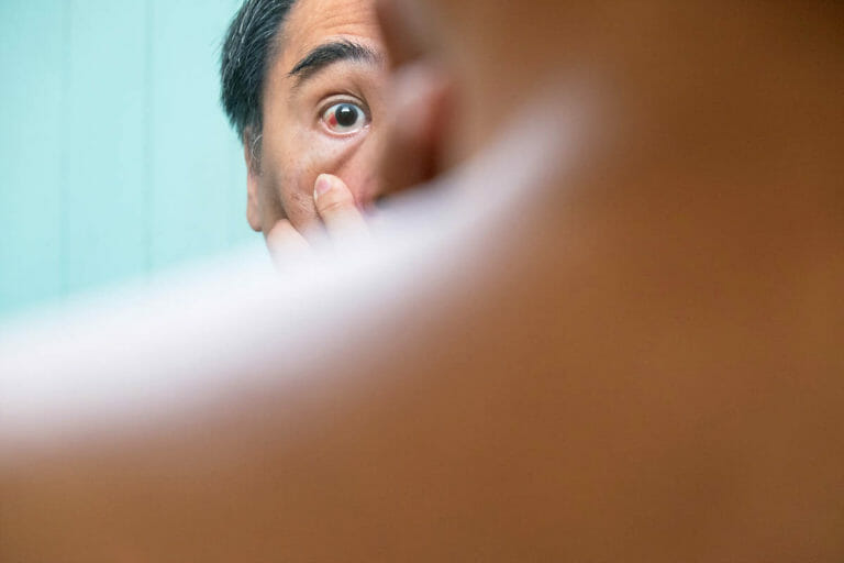 treat ocular rosacea