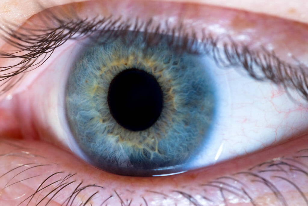 Anterior Uveitis