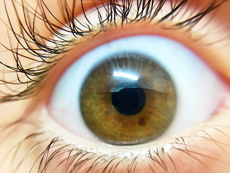 white eye discharge