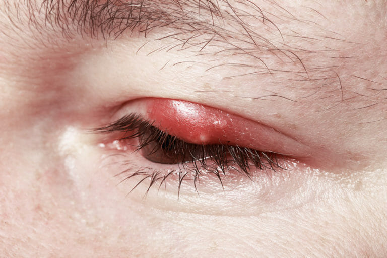 MGD and Chalazion