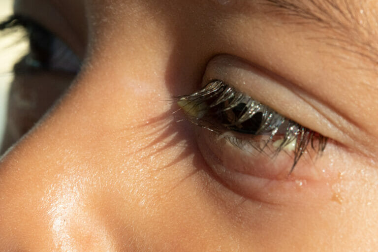 Blepharitis Symptoms