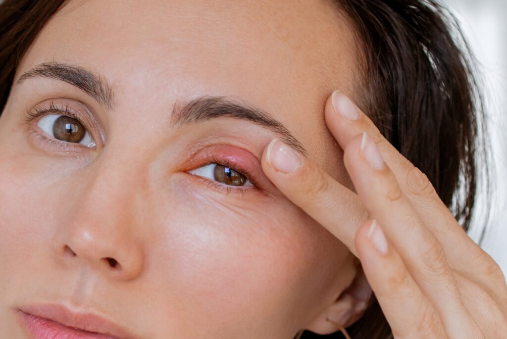 Chalazion - 12 Steps for Using a Hot Compress 1 Chalazion management