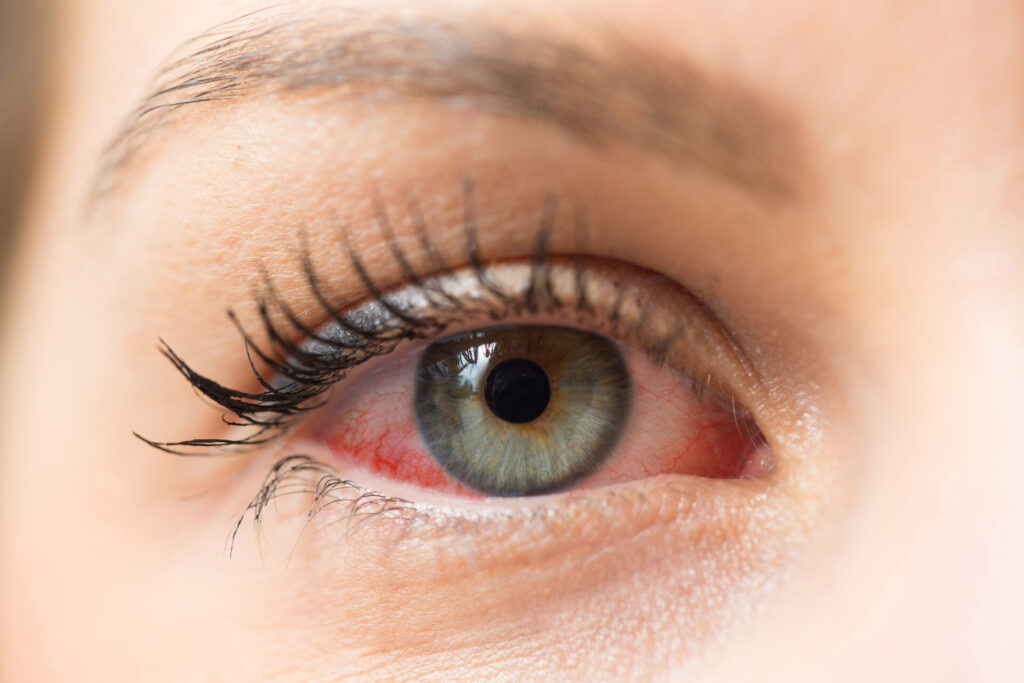 Ocular Rosacea