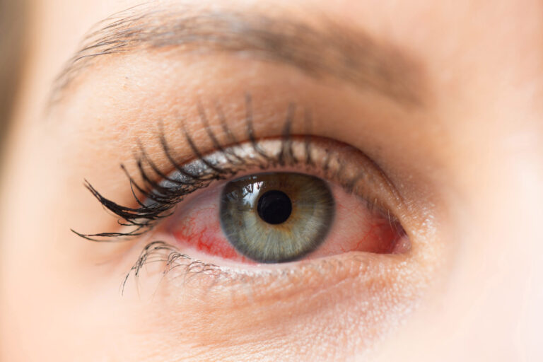Ocular Rosacea