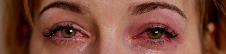 Watery eyes