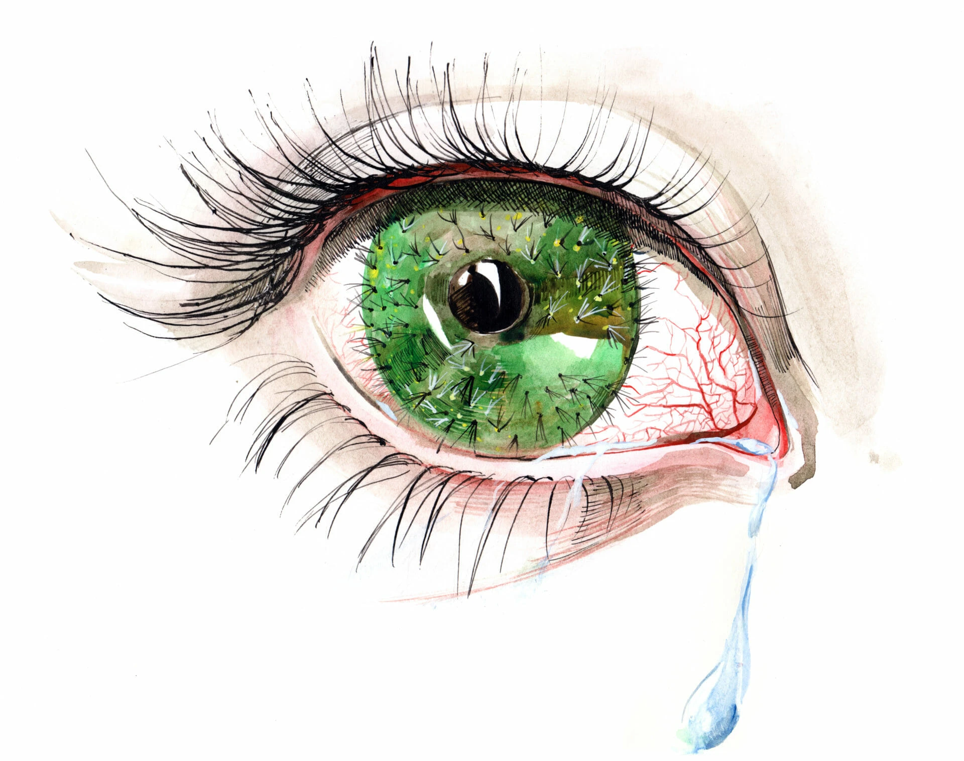 dry eye syndrome
