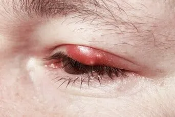 antibiotic ointment stye