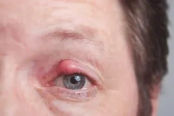 chalazion on eyelid