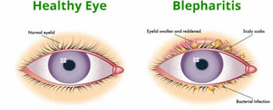 Blepharitis/ Dry Eyes