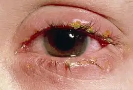 Crusty eyes treatment