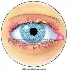Blepharitis treatment