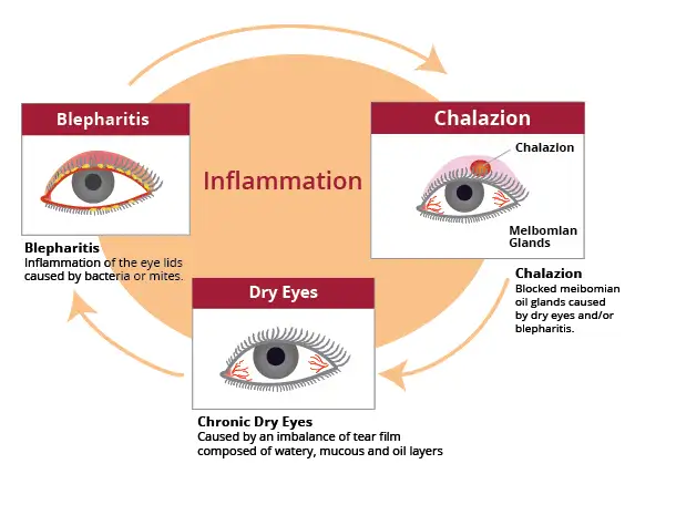 Treating a Chalazion (Chalazia) 2 Chalazion Illustration V3