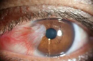 dry eyes treatment
