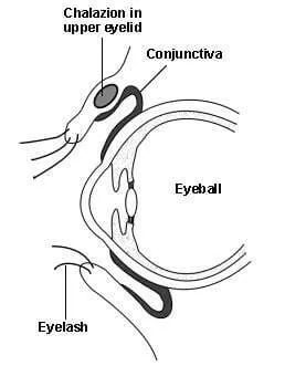 Chalazion