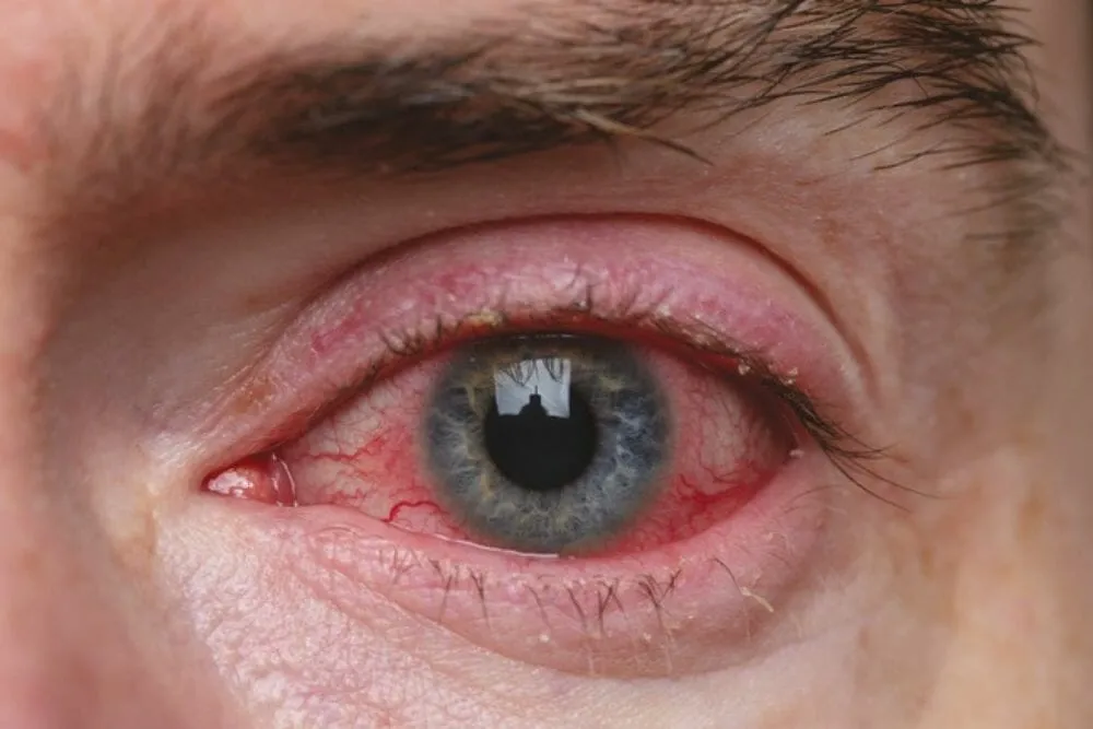 How To Get Your Ocular Rosacea Under Control - TheraLife 1 Dry Eye Relief